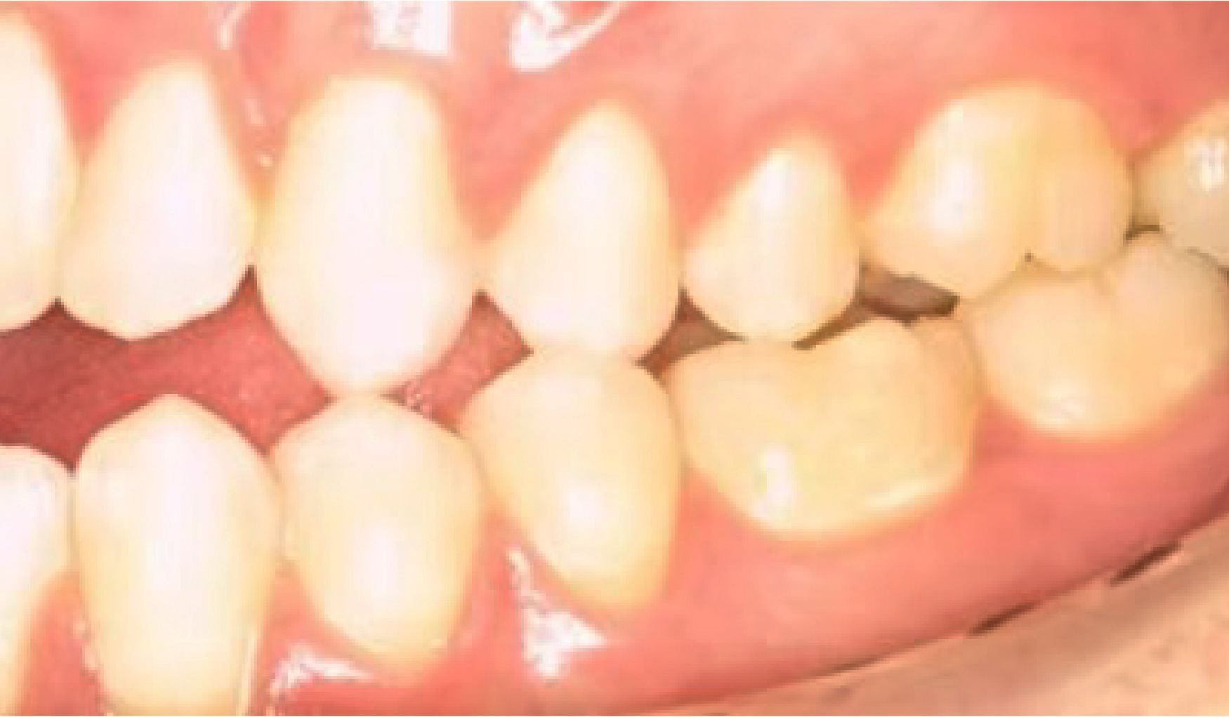 Braces Doc Before and After