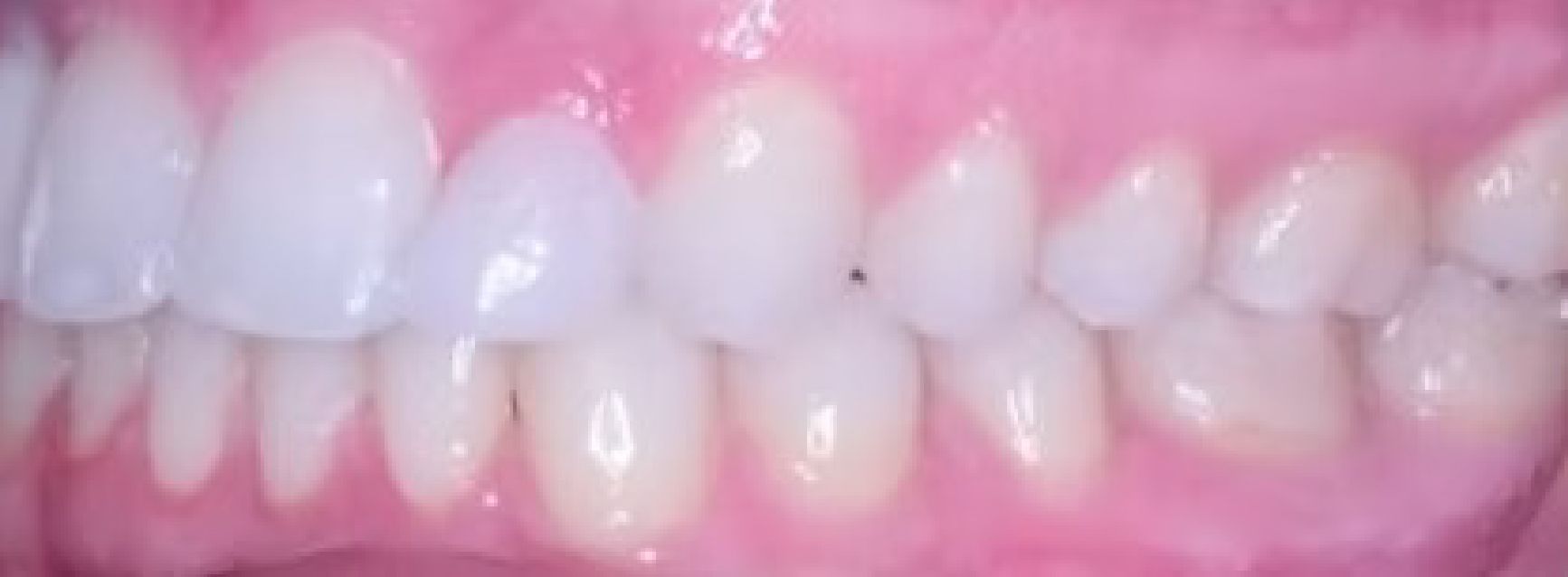 Braces Doc Before and After