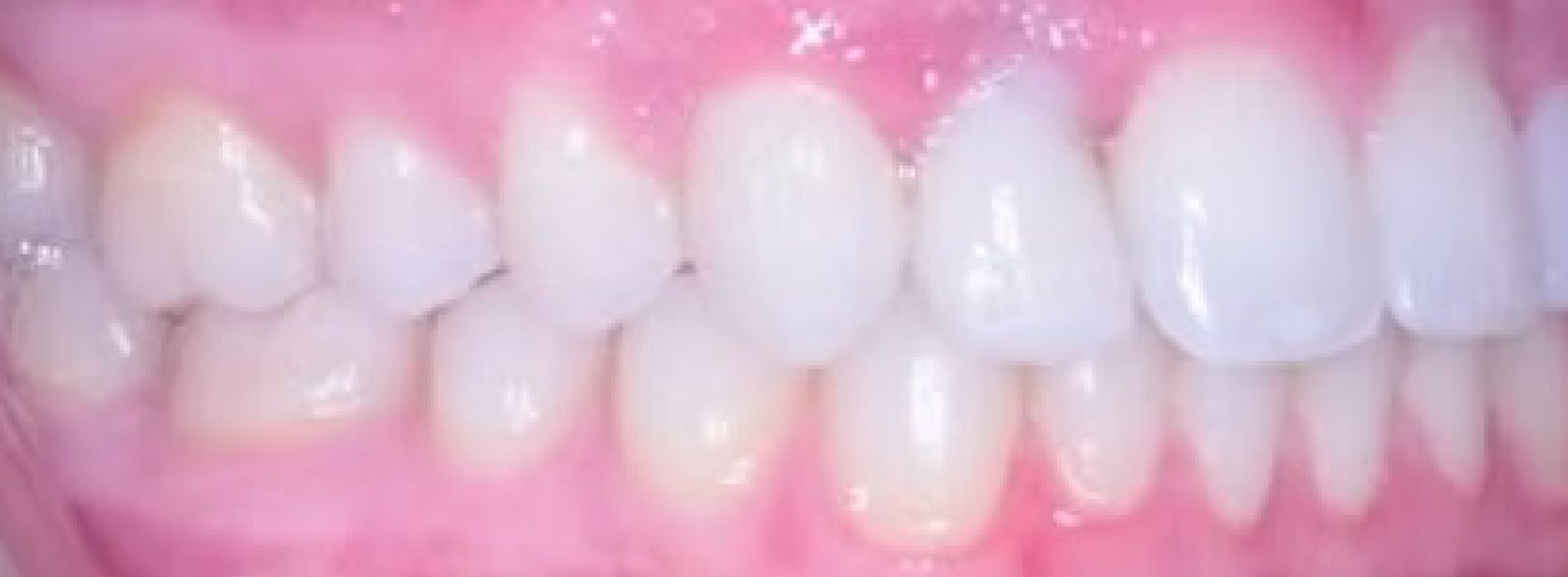 Braces Doc Before and After