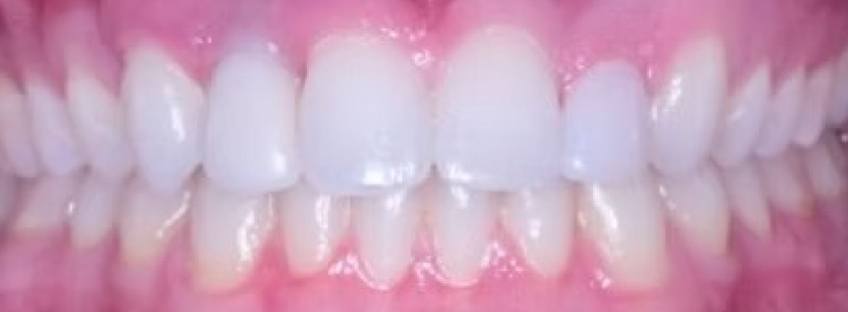Braces Doc Before and After