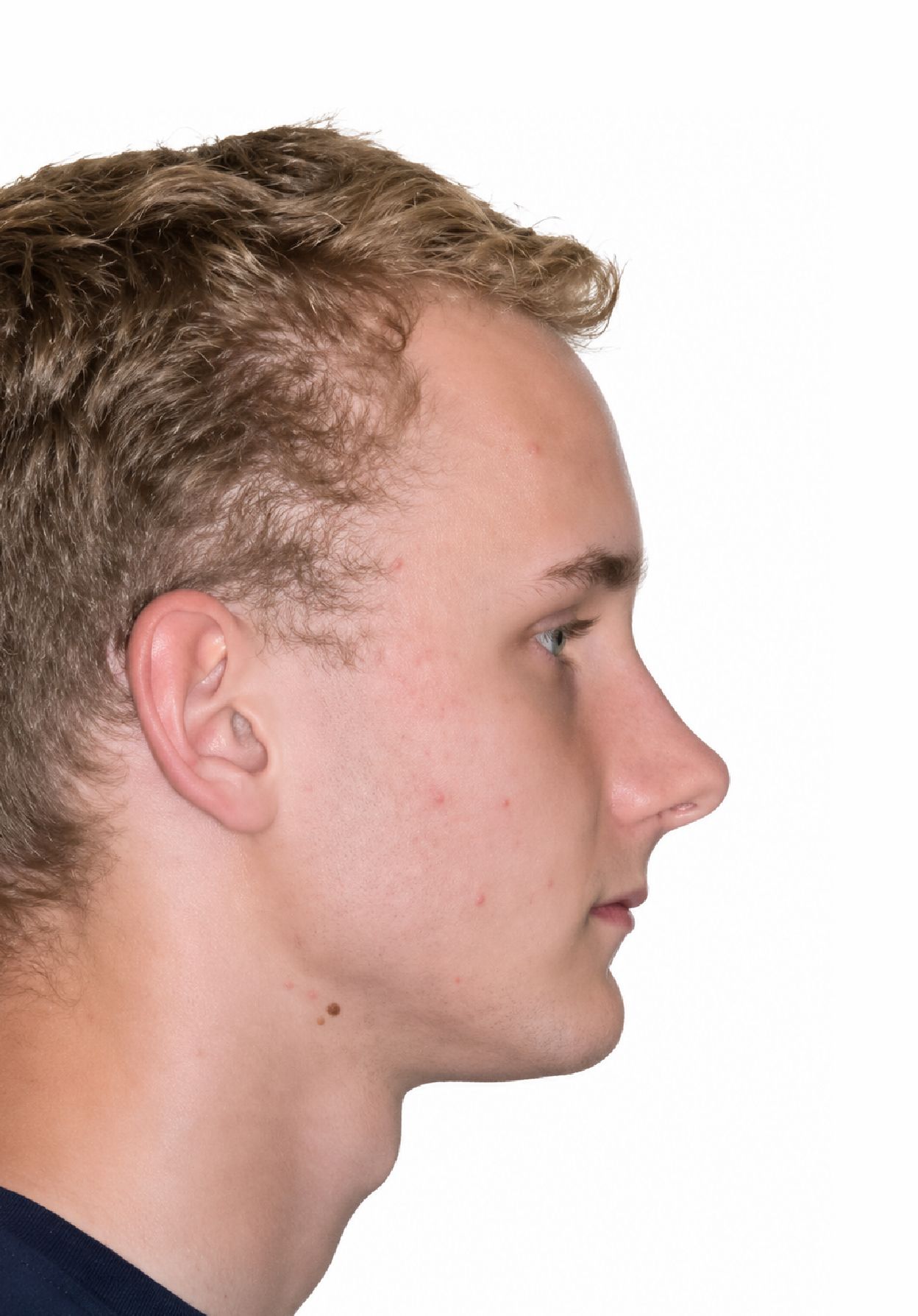 Braces Doc Before and After