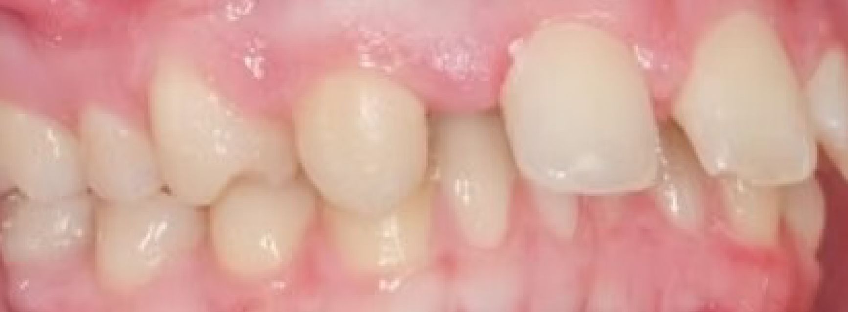 Braces Doc Before and After