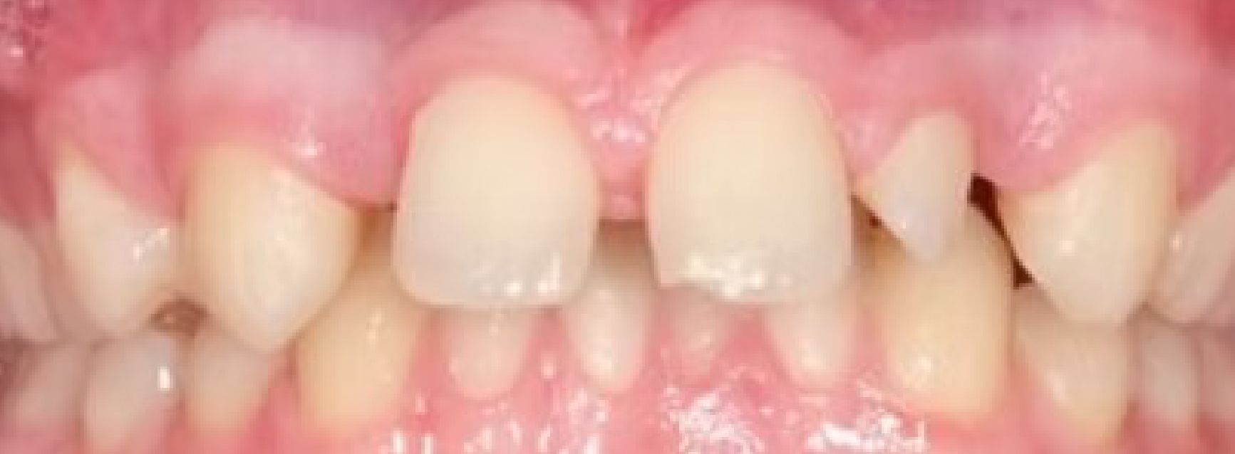 Braces Doc Before and After