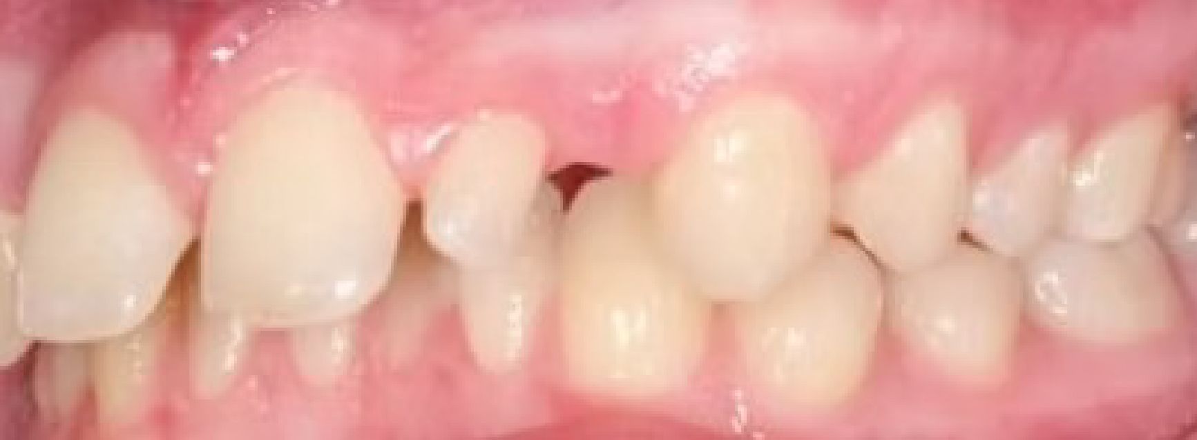 Braces Doc Before and After