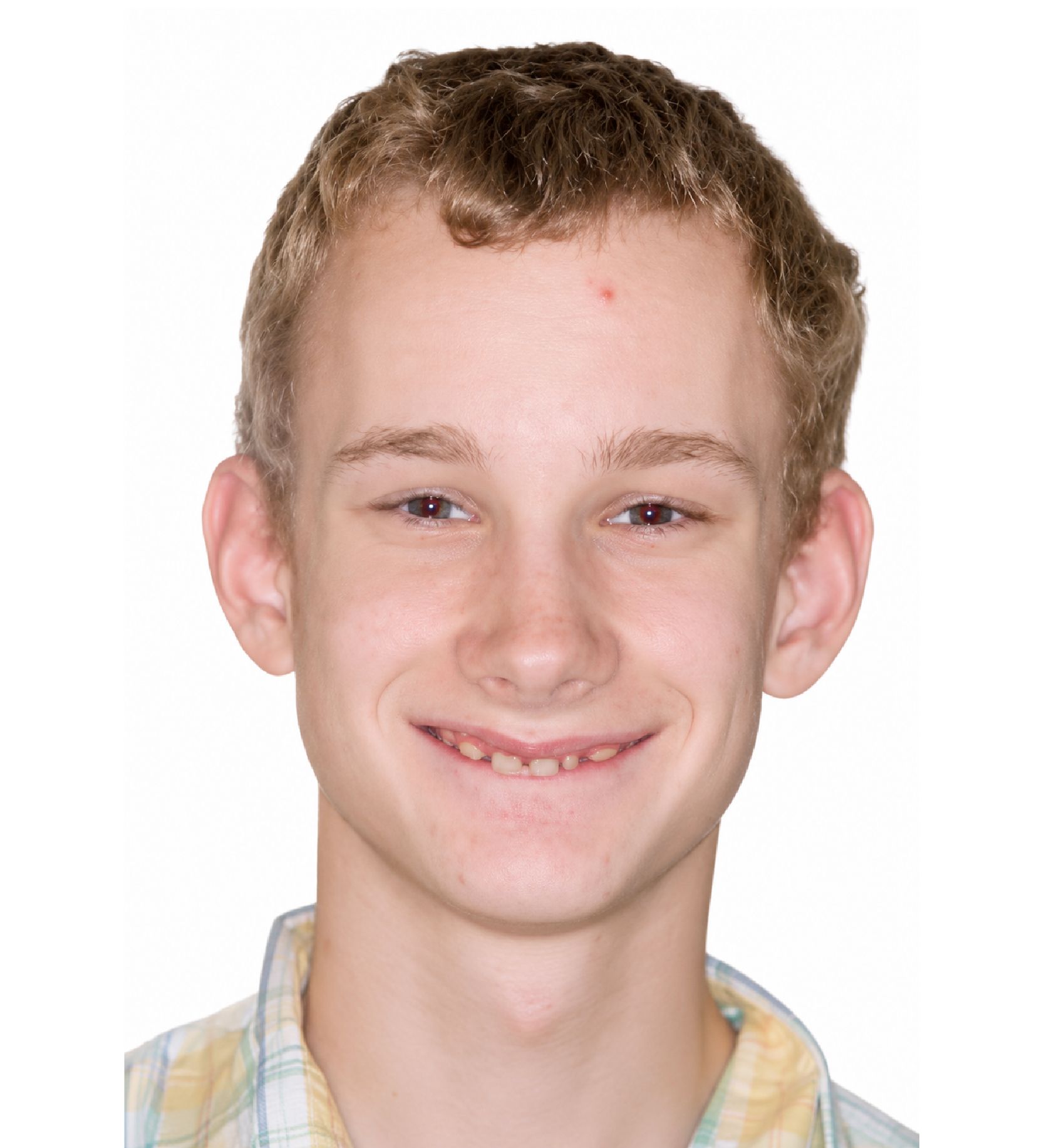 Braces Doc Before and After