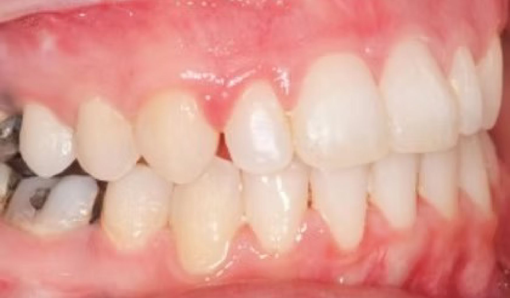 Braces Doc Before and After