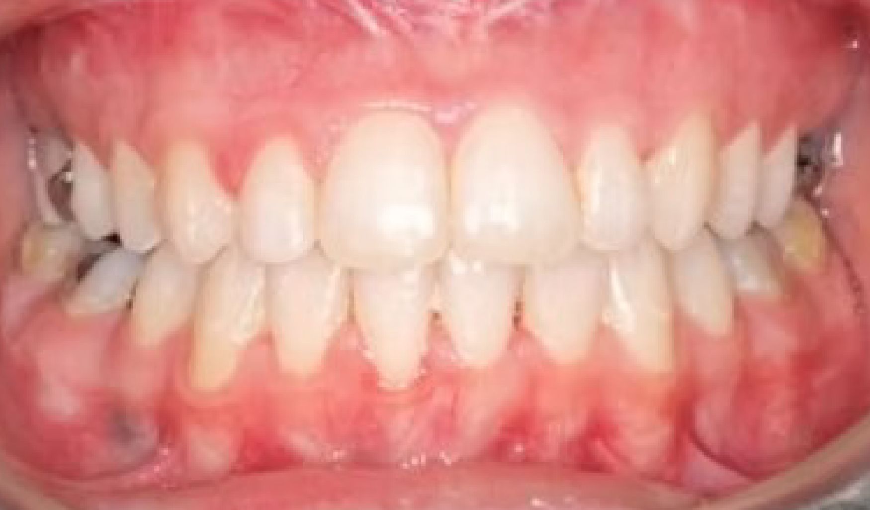 Braces Doc Before and After