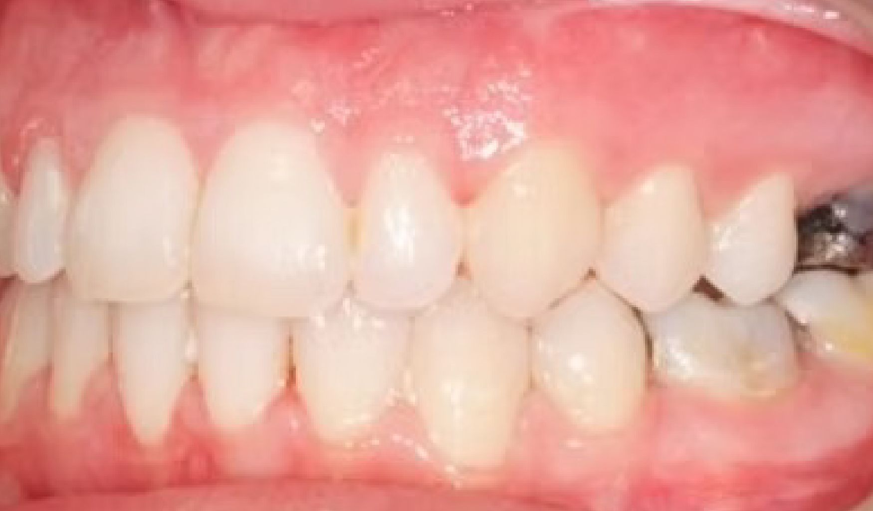 Braces Doc Before and After
