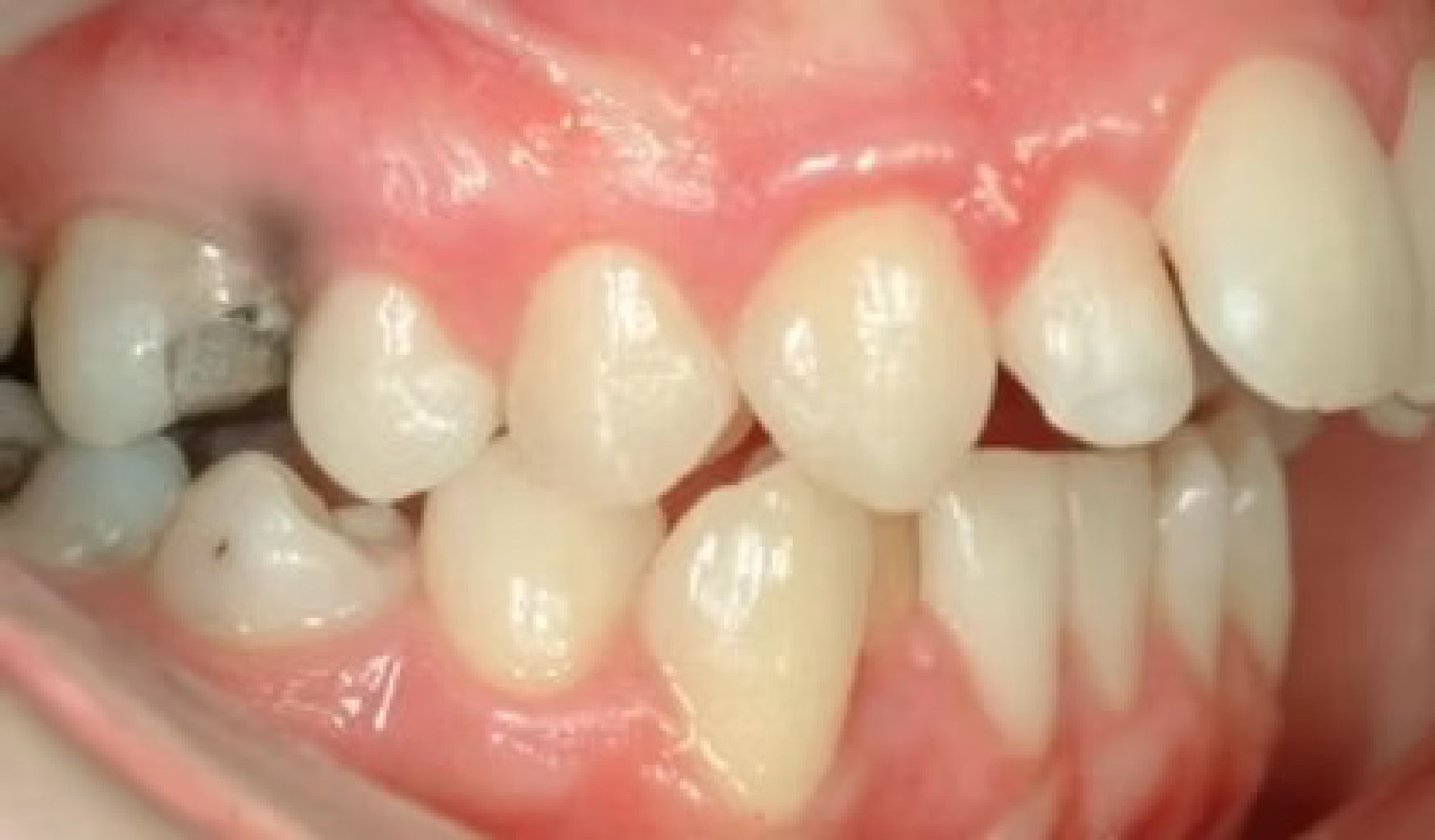 Braces Doc Before and After