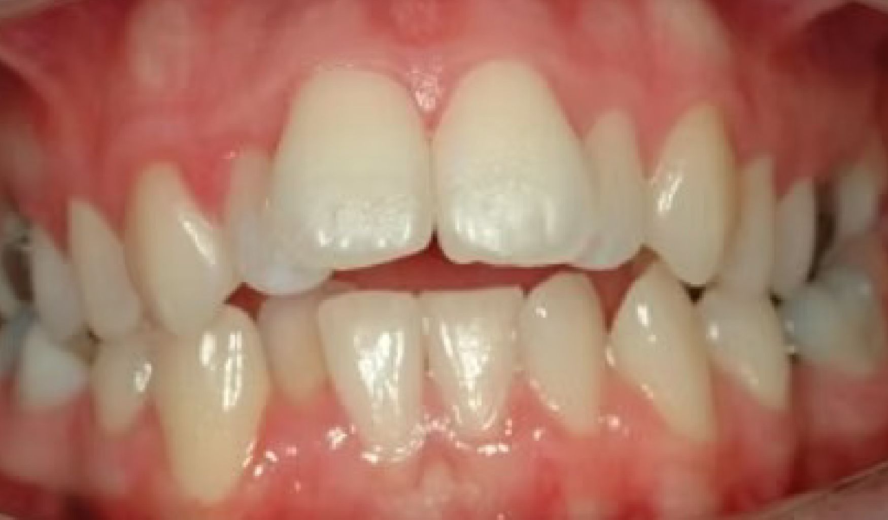 Braces Doc Before and After