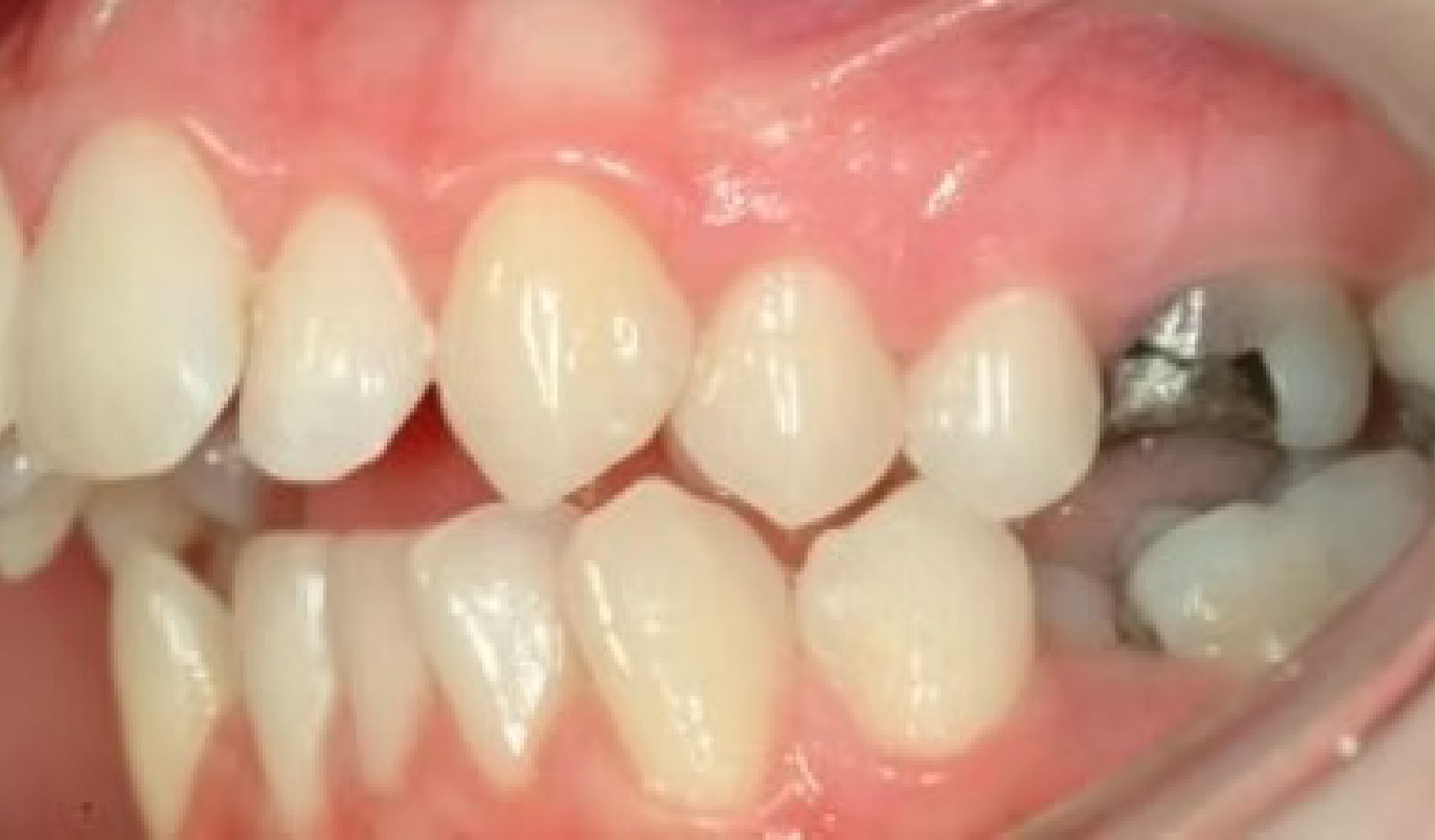 Braces Doc Before and After