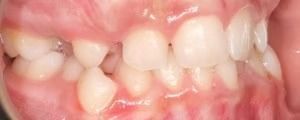 Braces Doc Before and After