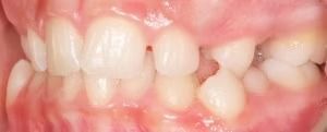 Braces Doc Before and After