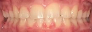 Braces Doc Before and After