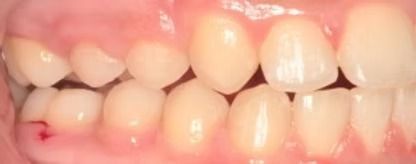 Braces Doc Before and After
