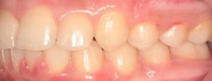 Braces Doc Before and After