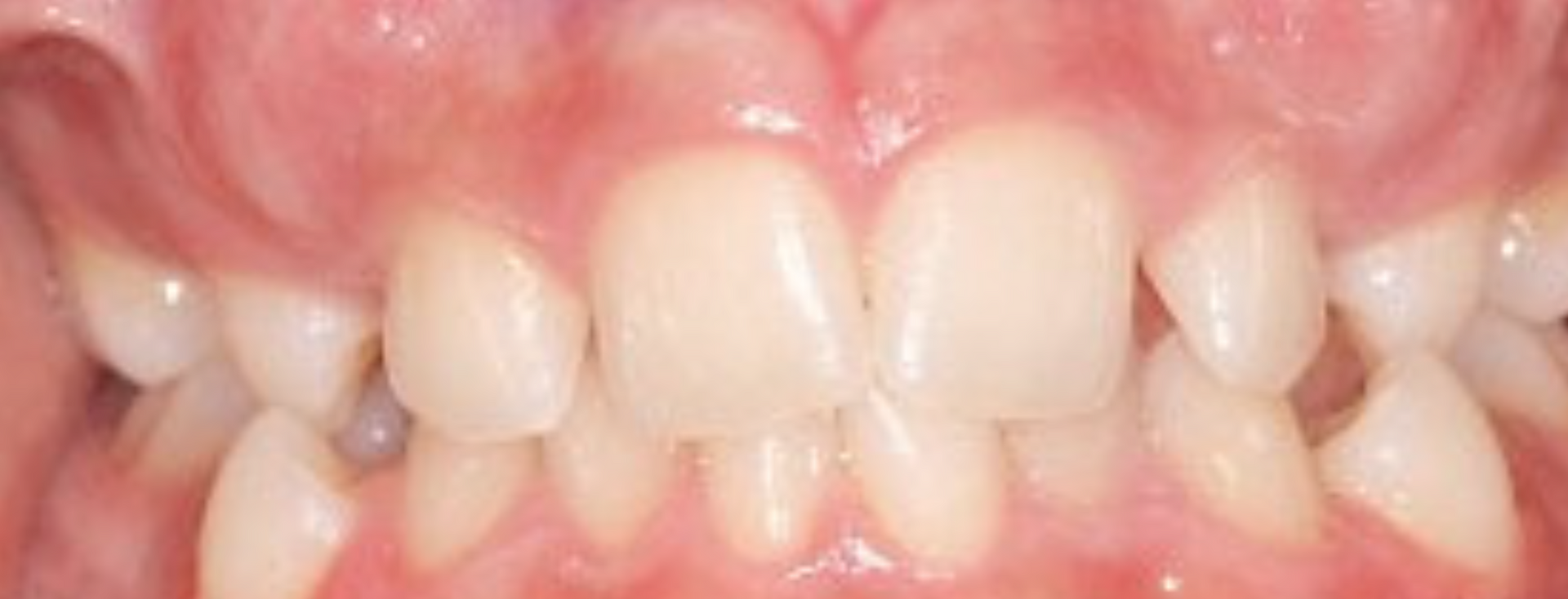 Braces Doc Before and After