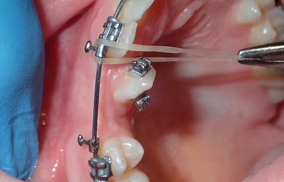 Close-up of dental braces adjusting a tooth with a transparent elastic band and metal wire