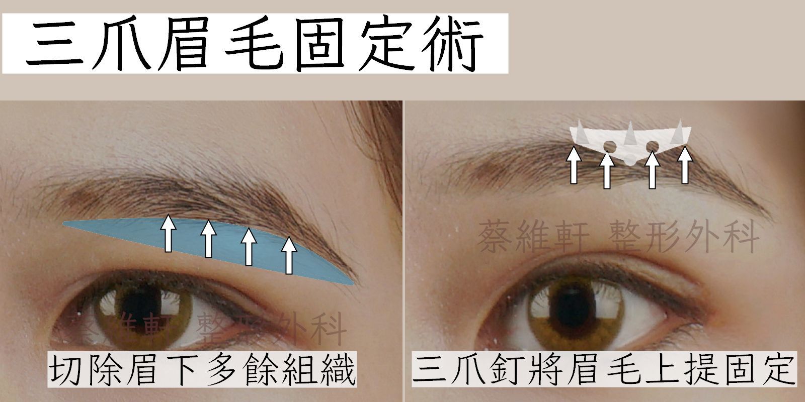眉下切+三爪眉毛固定術