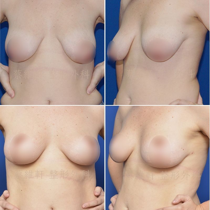 倒T型提乳:單純提乳,未使用假體隆乳。