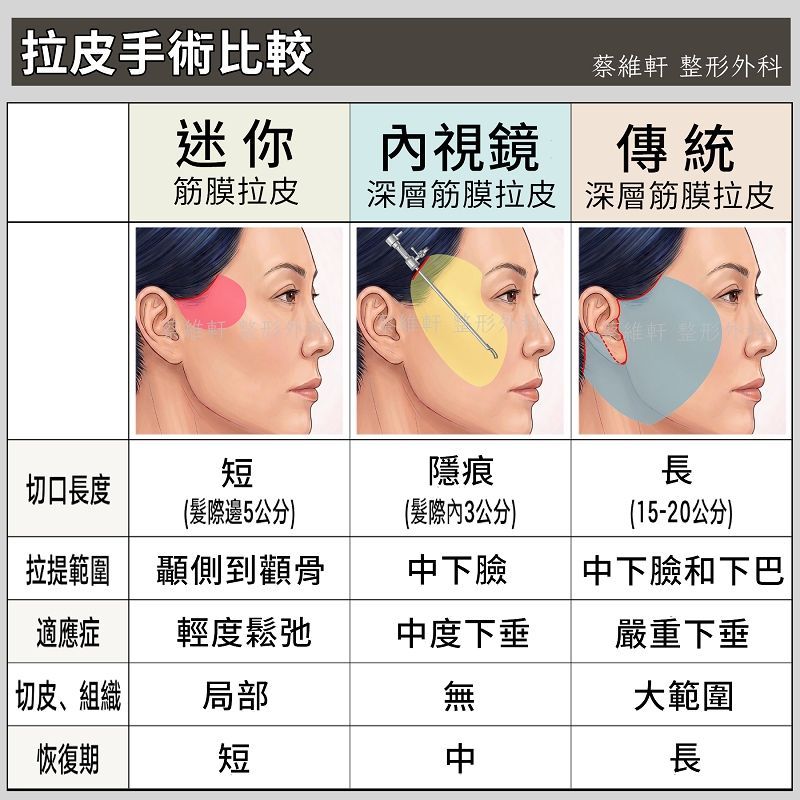 內視鏡深層筋膜拉皮、迷你筋膜拉皮、傳統深層筋膜拉皮手術比較。差異在於傷口長度與位置、合併切皮的量、拉提範圍、適合不同嚴重度、還有恢復期。