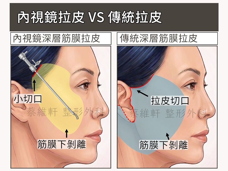 內視鏡深層筋膜拉皮與傳統深層筋膜拉皮的手術差異。內視鏡手術可以做到隱痕、安全、效果好的優點。