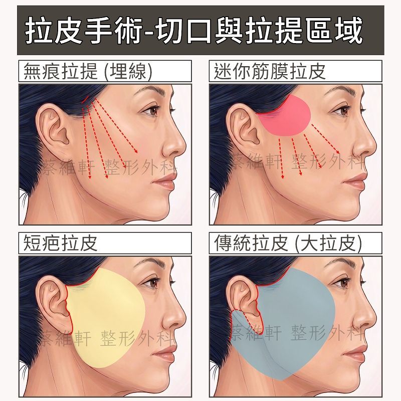 不同切口長度,可以拉提的範圍不同,發展出無痕拉提、迷你肌膜拉皮、短疤拉皮與傳統拉皮。