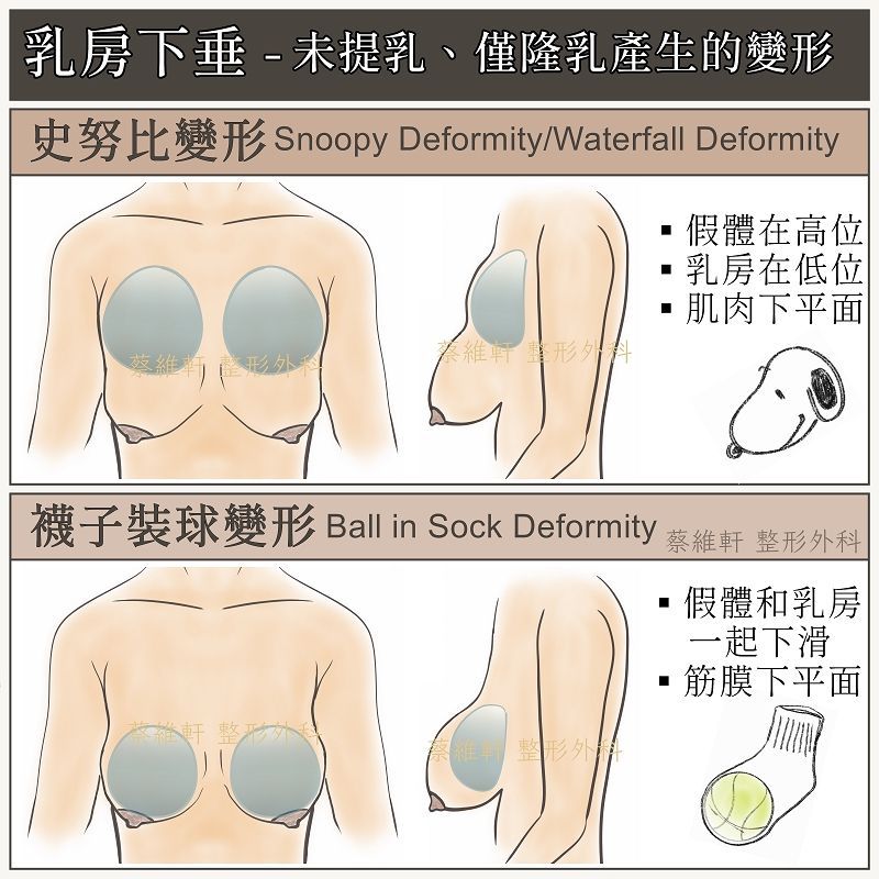 乳房萎縮與下垂,僅靠隆乳手術,可能產生史努比變形(Snoopy deformity)、瀑布變形(Waterfall deformity)與襪子裝球變形(Ball in sock deformity)