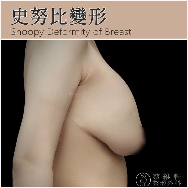 乳房萎縮與下垂,僅靠隆乳手術,可能產生史努比變形(Snoopy deformity)、瀑布變形(Waterfall deformity)與襪子裝球變形(Ball in sock deformity)