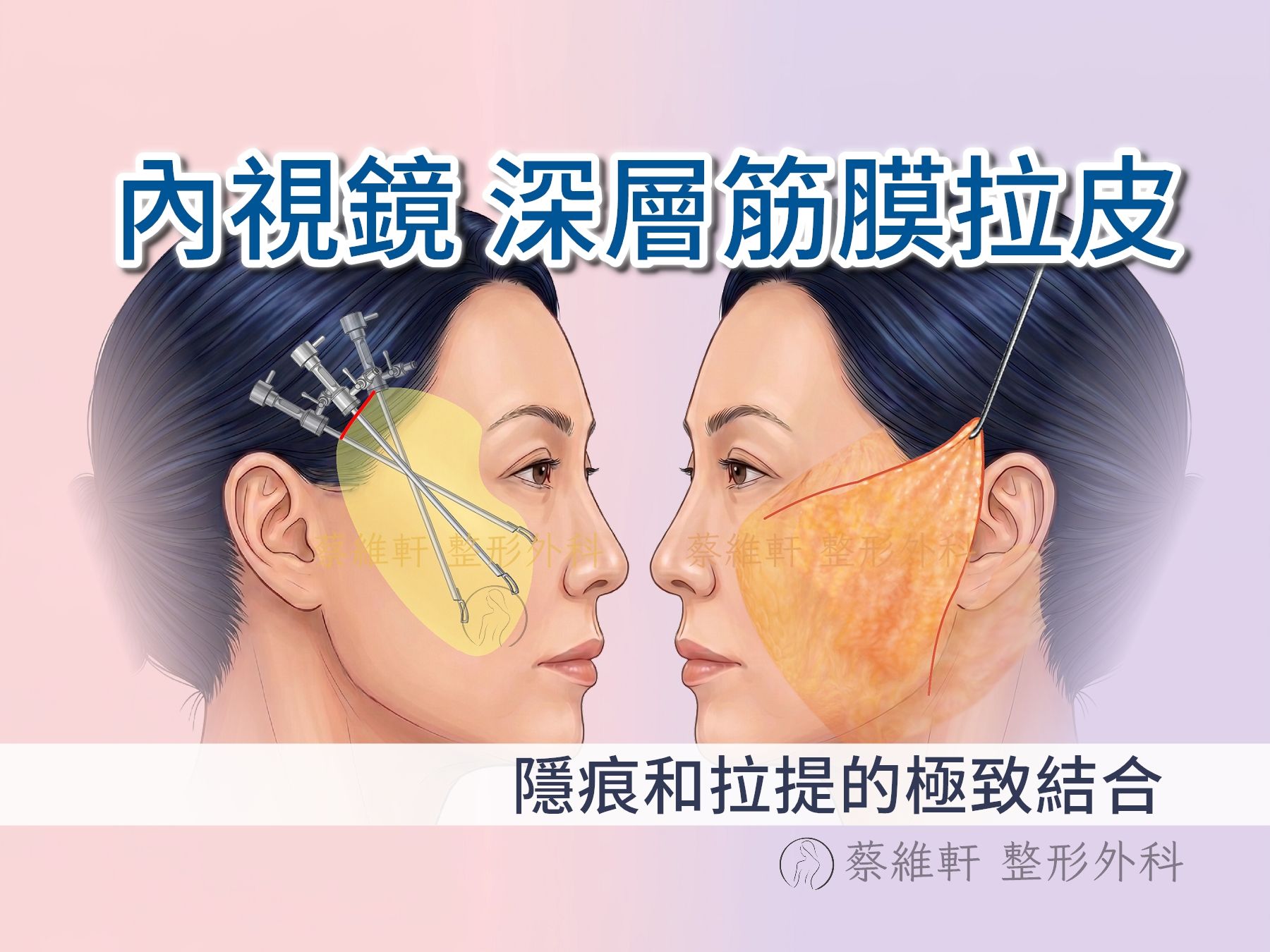 內視鏡深層筋膜拉皮（馬尾拉皮）兼顧隱痕與深層拉提！整形外科蔡維軒醫師詳解手術原理、特點與適合族群，並完整整理內視鏡、迷你筋膜（MACS）與傳統拉皮比較表，帶您掌握微創拉提最新趨勢，告別熟齡與減重後的臉