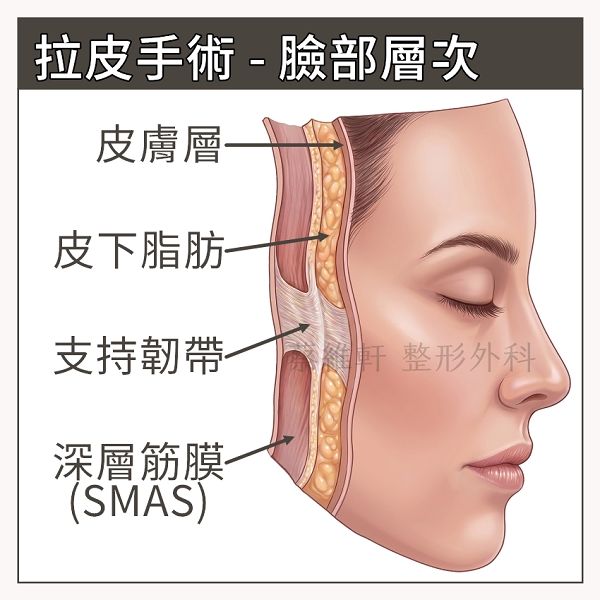 拉皮手術層次
SMAS筋膜才是重點,不能只拉皮