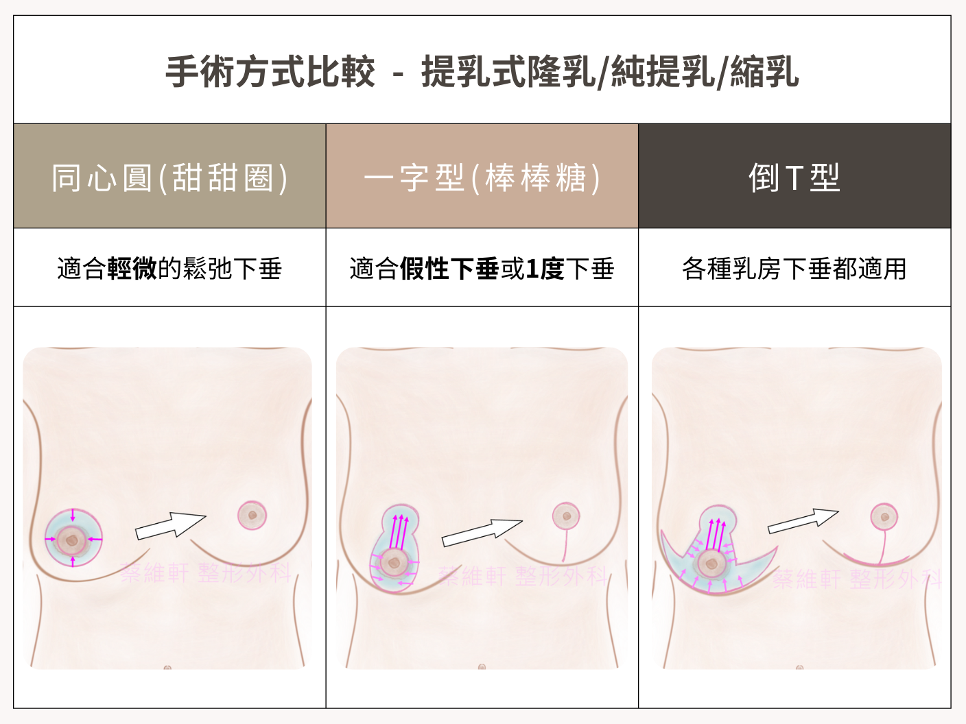 三幅乳房插圖,顯示乳頭相對於乳房輪廓的不同位置。