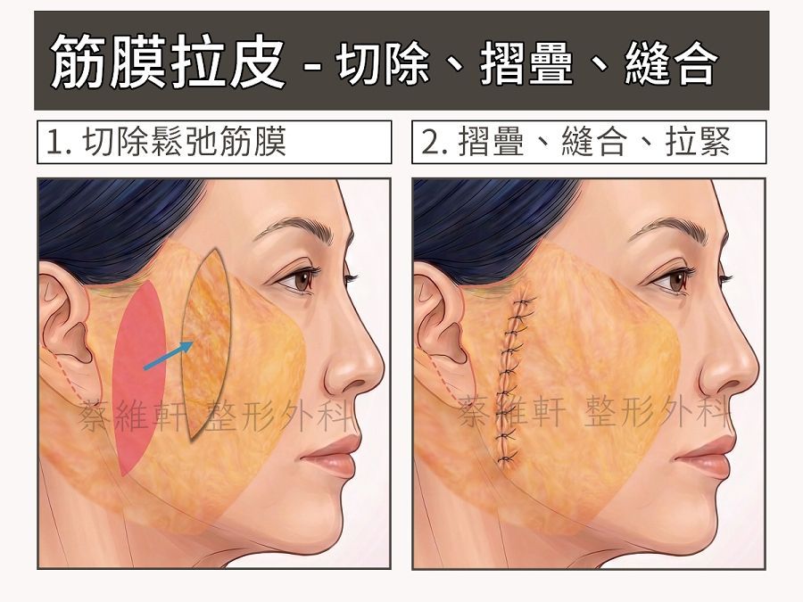 筋膜拉皮:從筋膜表面,透過切除、摺疊、縫合的方式來拉緊組織。
SMAS facelift,excision, imbrication, plication, smasectomy