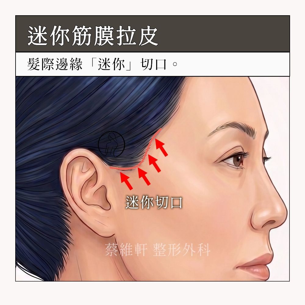 迷你筋膜拉皮，髮際到耳前的迷你切口，約5公分左右。