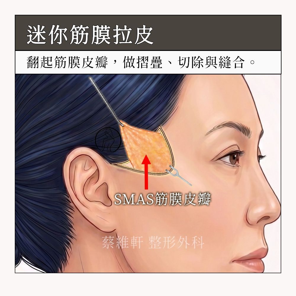 迷你筋膜拉皮，翻起SMAS筋膜皮瓣，做拉提、折疊、縫合和切除，達到有效且持久的拉提效果。