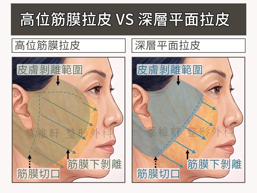 「高位筋膜拉皮」vs「深層平面拉皮」
共同點都會進入筋膜下深層平面,差異點在於皮膚剝離範圍,以及筋膜切口。