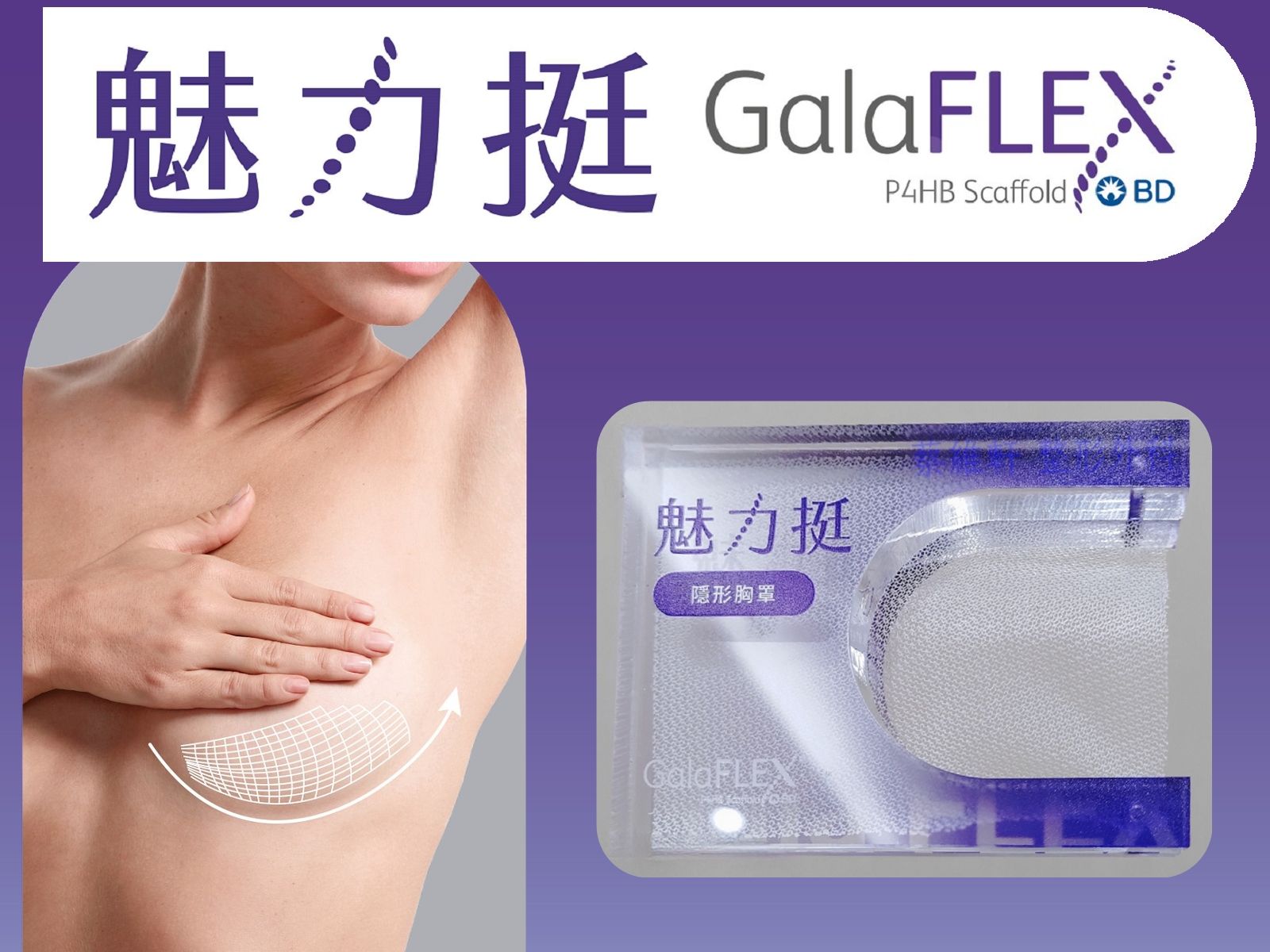 圖中描繪了一名女性的軀幹,其中一側乳房增大,粉紅色箭頭指示可能的隆乳手術部位。
