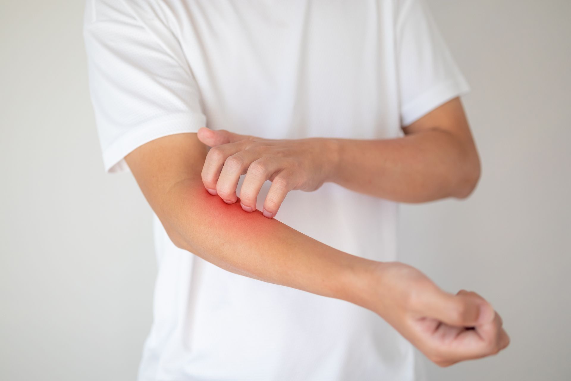 Dermatitis rash on the arm causing redness and itching. Dermatitis rash on the arm causing redness and itching.