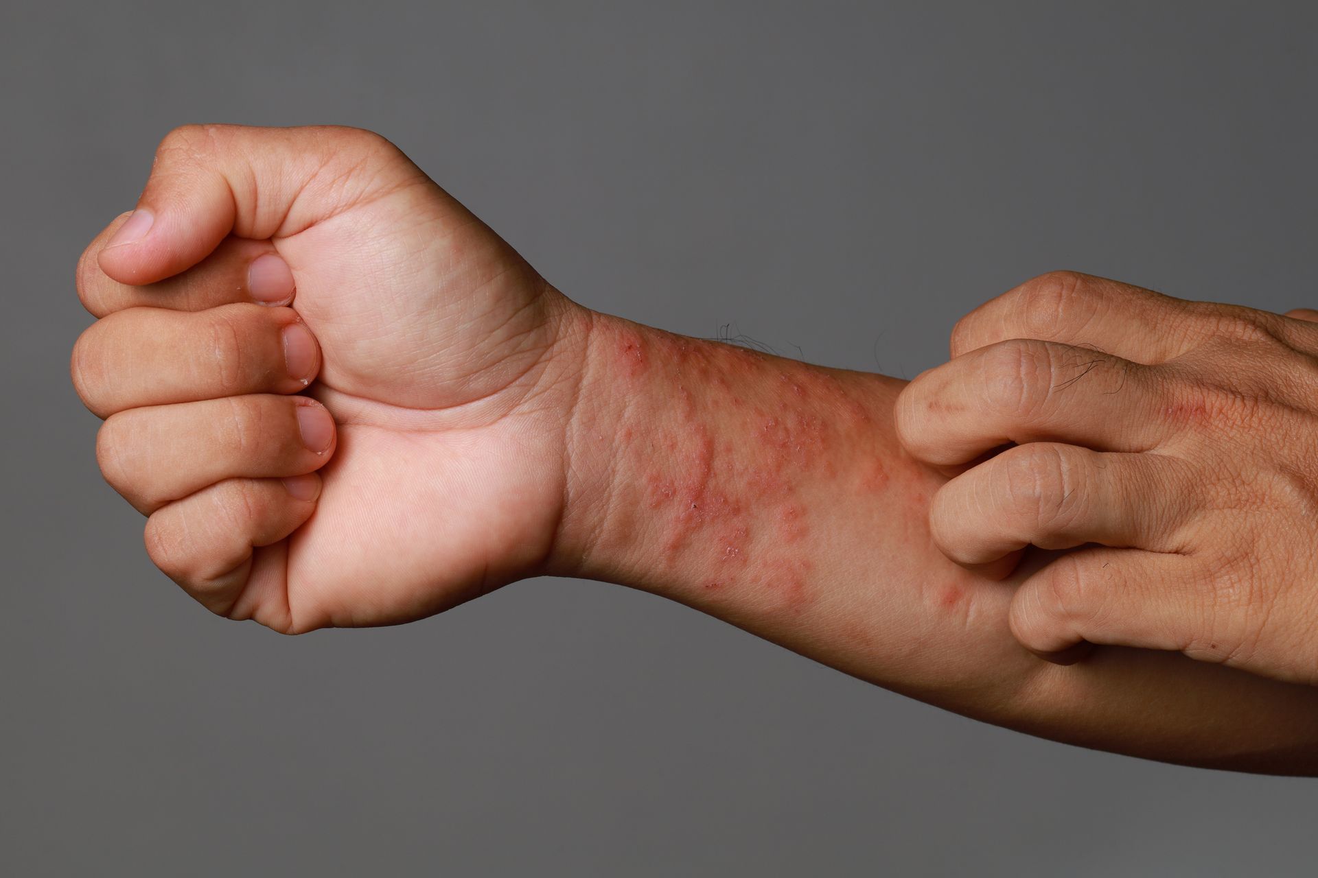 Close up allergic rash dermatitis eczema skin of patient wrist. Close up allergic rash dermatitis eczema skin of patient wrist.