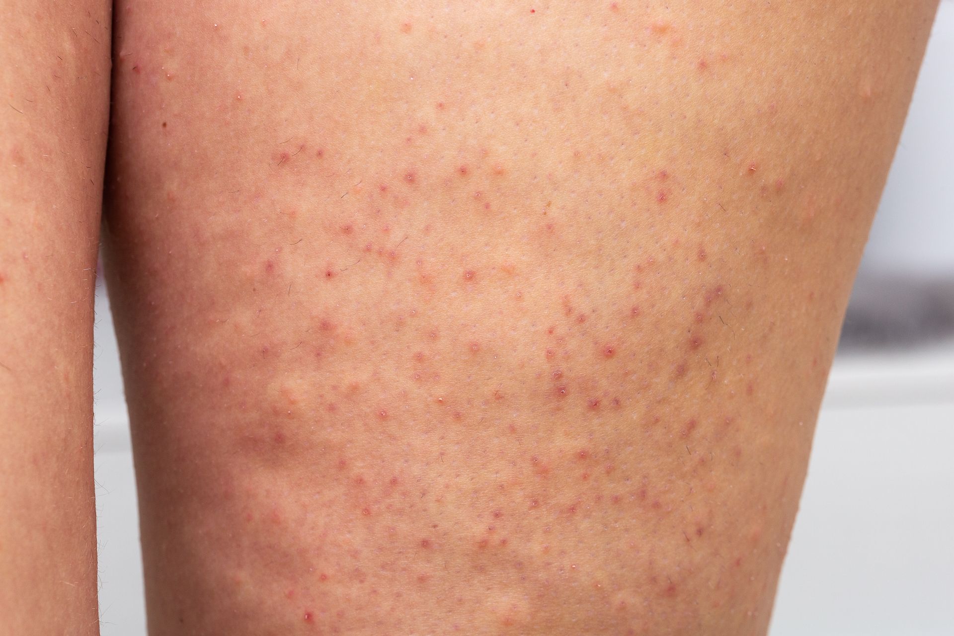 Close-up of woman's legs with keratosis pilaris
