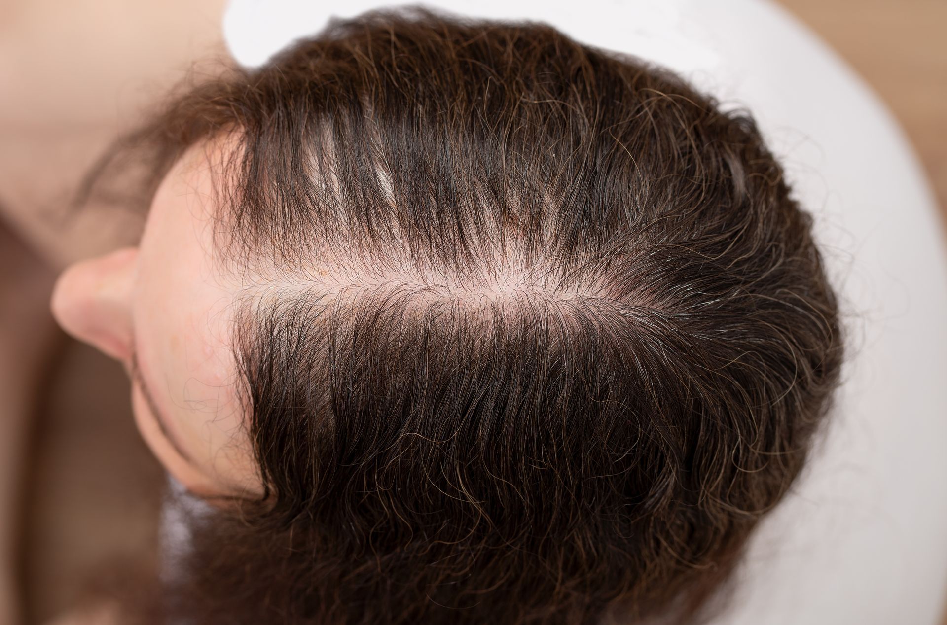 A woman with hair loss on the top of her head. A woman with hair loss on the top of her head.