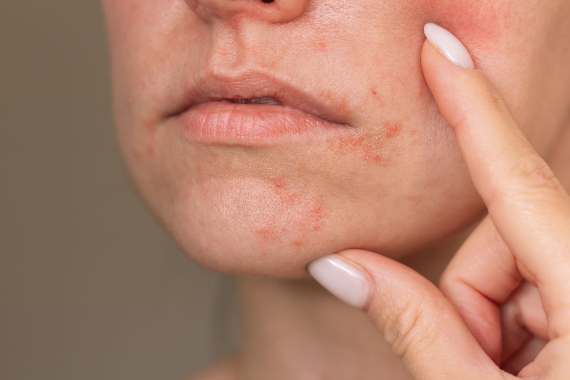 Woman pointing to a facial dermatitis breakout showing redness and scaling near the lips.