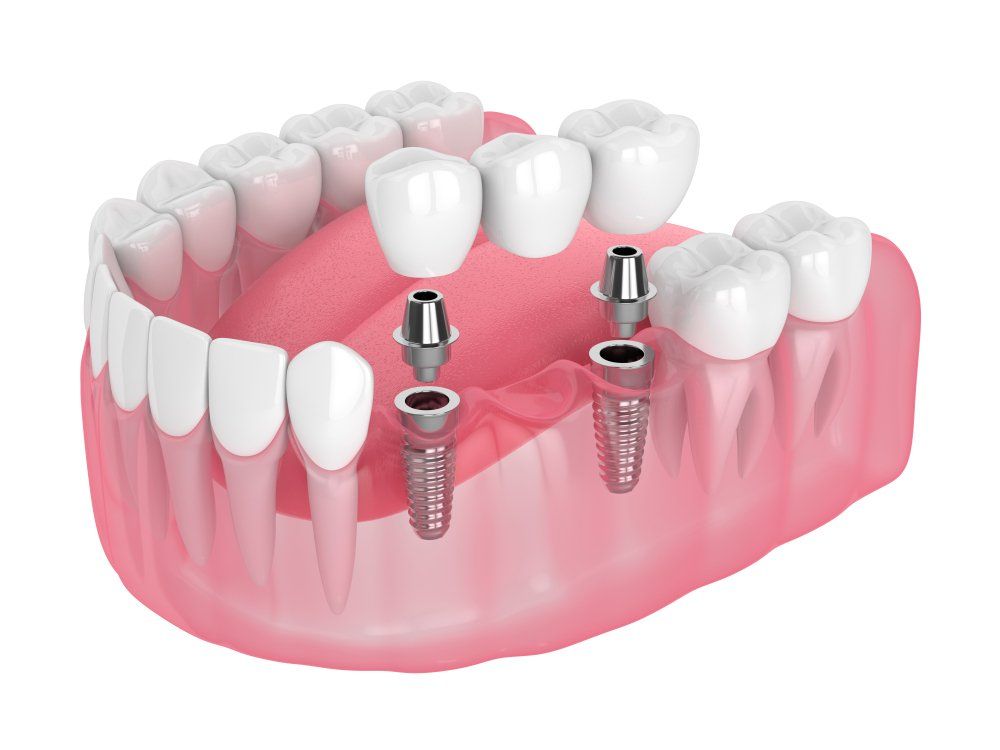 Un rendu 3D d'un pont dentaire avec implants dentaires.