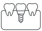 Un dessin au trait d'un implant dentaire entre deux dents.