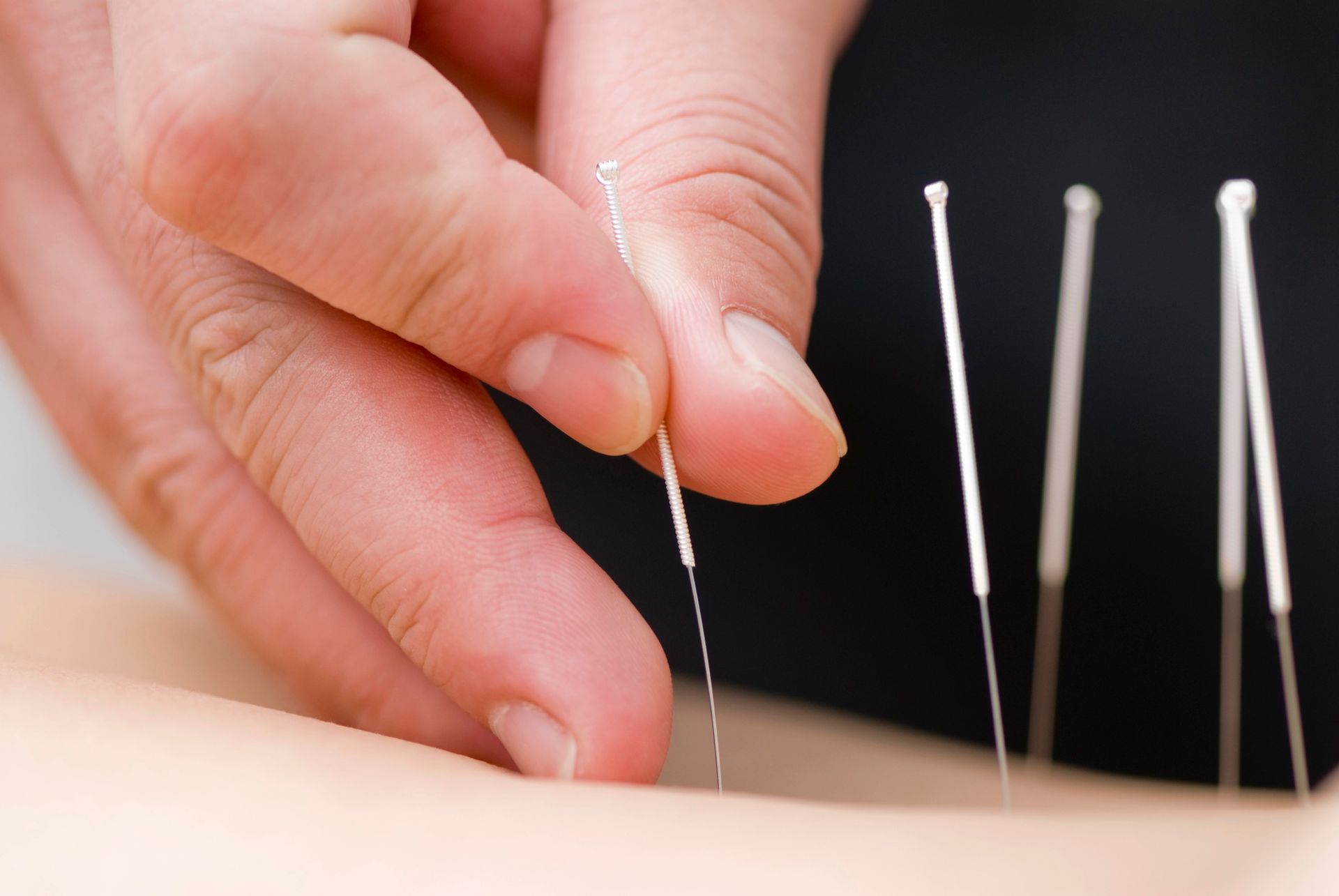 Dry Needling in Westbury, NY