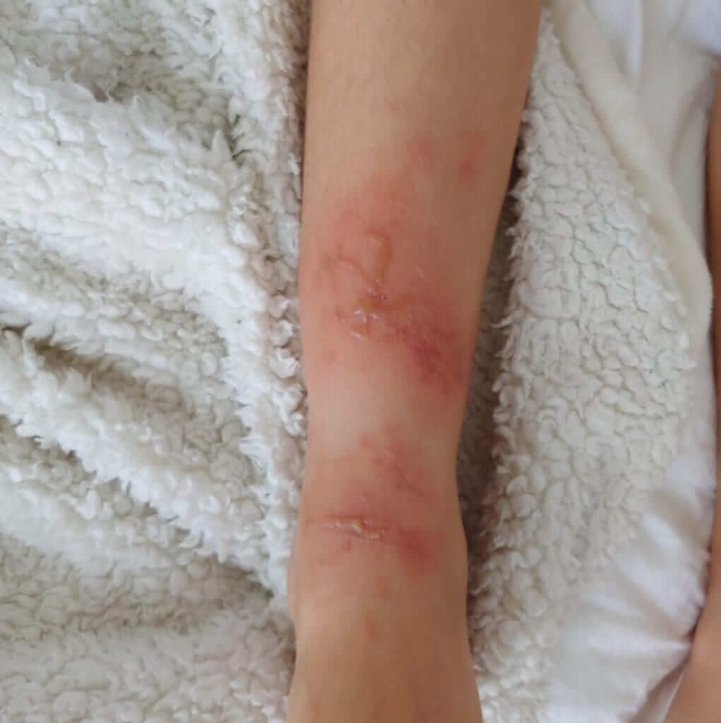 What a sting may look like on a victim What a sting may look like on a victim