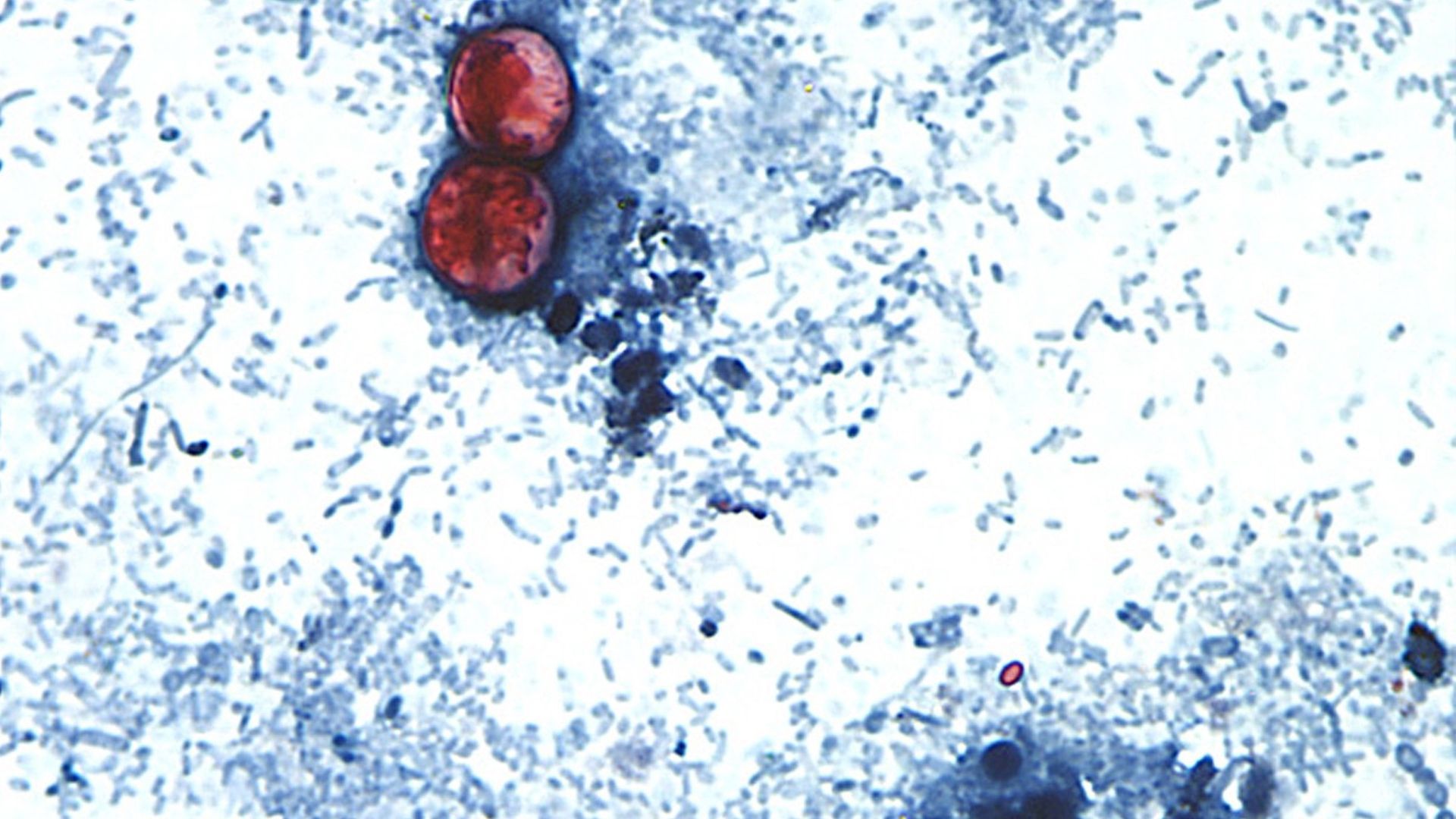 Cyclospora Cases in Alabama Cyclospora Cases in Alabama