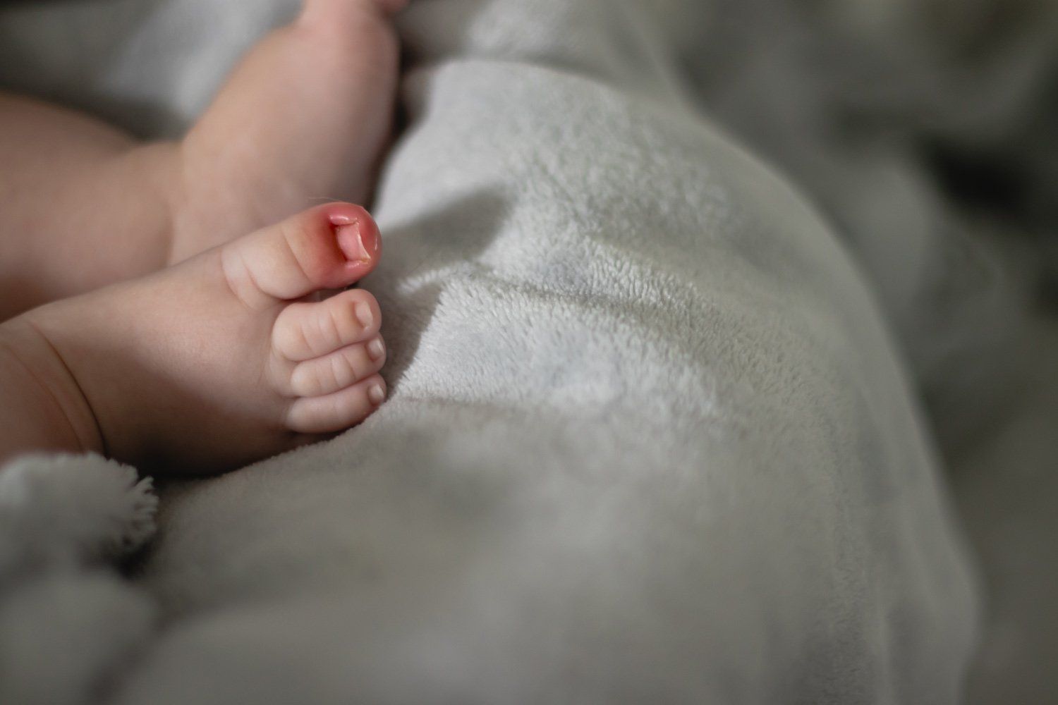 Ingrown Toenails | Norwest, NSW | Amy McElveney Podiatry