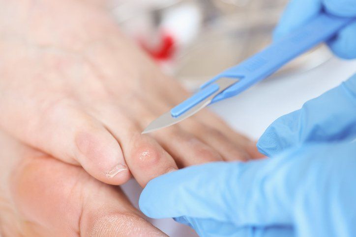 Corns And Callouses | Norwest, NSW | Amy McElveney Podiatry
