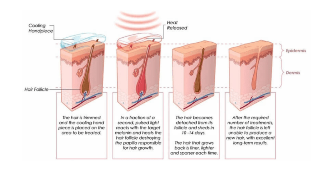 Diagram showing laser hair removal process: laser damages hair follicle, leading to hair loss and reduced growth.